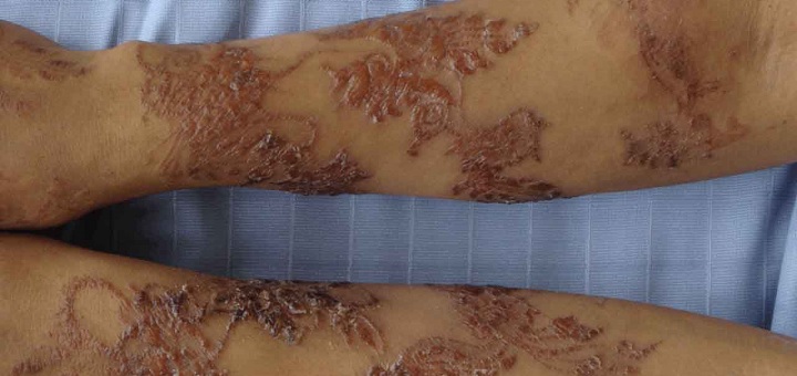 British Skin Foundation warns against use of 'black henna' temporary tattoos