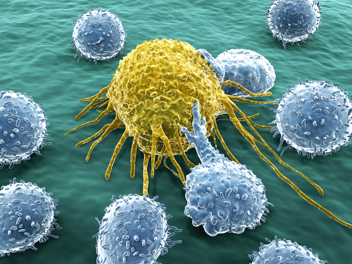 Cancer cell and lymphocytes
